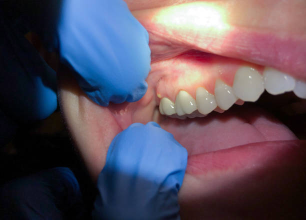 Best Tooth Infection Emergency Dentist  in Ol, LA